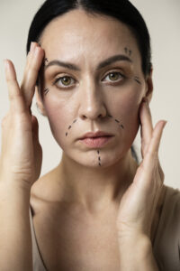 Development of fine lines and wrinkles